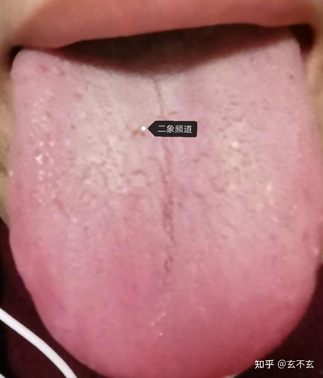 肾阴虚舌苔图片