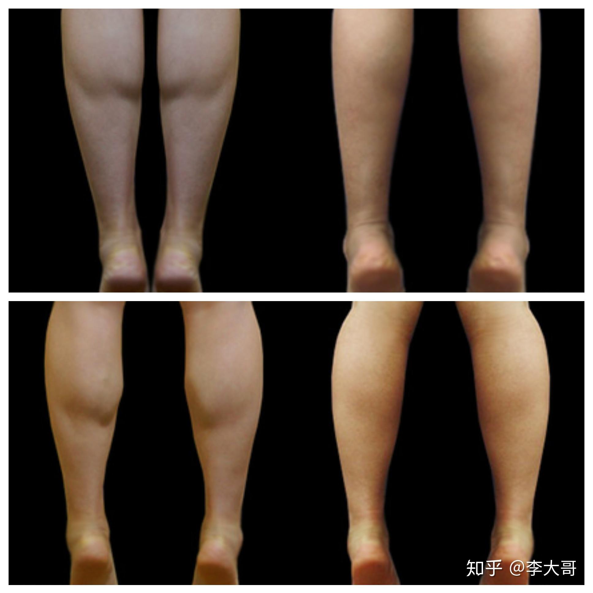 怎么快速瘦小腿肌肉最有效神经显微瘦小腿靠谱吗