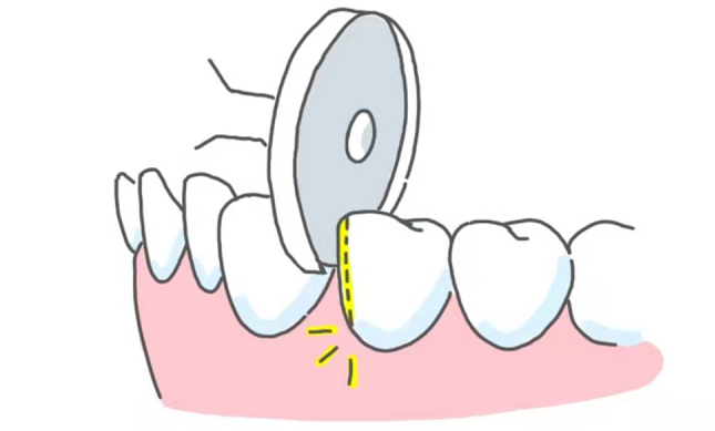 牙齿矫正的邻面去釉和片切分别是什么有何区别