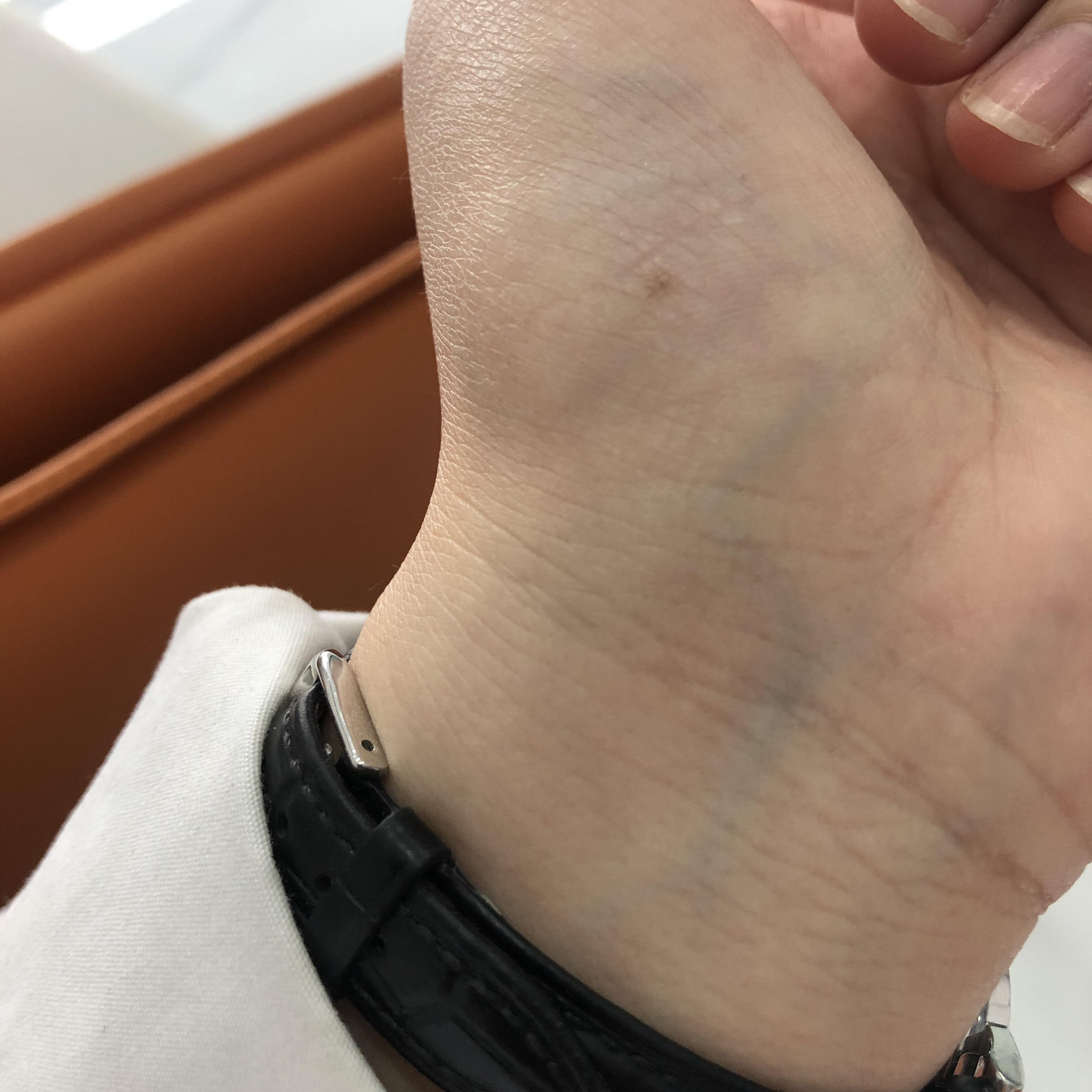 左手大鱼际有颗痣? - 知乎