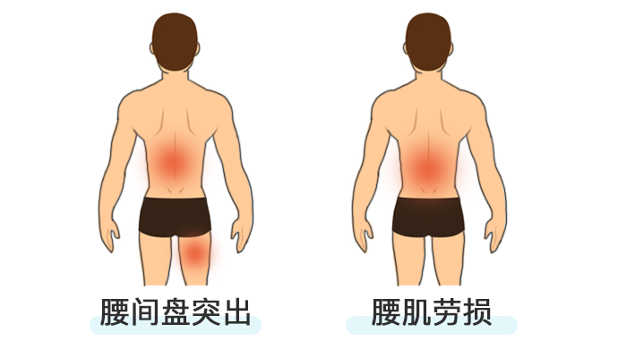 腰疼怎么鉴别是腰肌劳损还是腰间盘突出