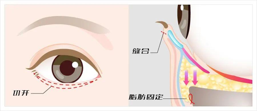 眶隔脂肪释放——脂肪转移，改善眼袋与泪沟凹陷！ - 知乎