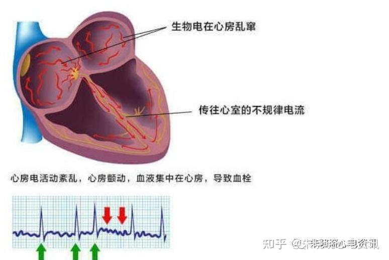 房颤基本知识