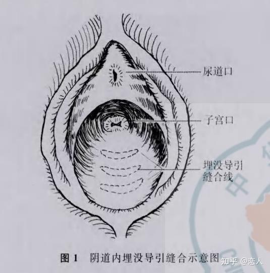 为了更紧致居然在私处埋线 真的有用吗