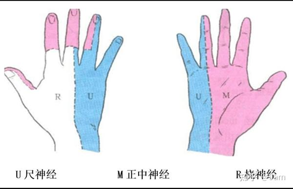 记录尺神经麻痹（无名指和小指发麻）康复历程 - 知乎