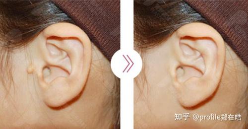 附耳切除会留疤吗?来看看附耳切除前后对比照片你就知道了