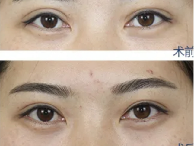 双眼皮有肉条感怎么办长沙有哪些做眼修复比较好的医生