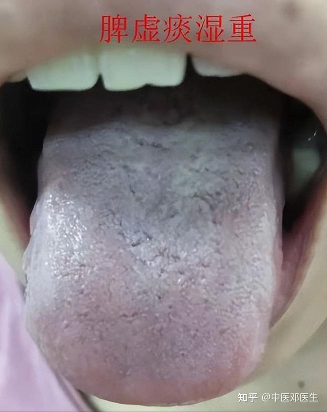 脾虚痰湿重:舌质暗红或淡白,苔厚腻,偏白或偏黄编辑搜图脾气虚舌象:舌