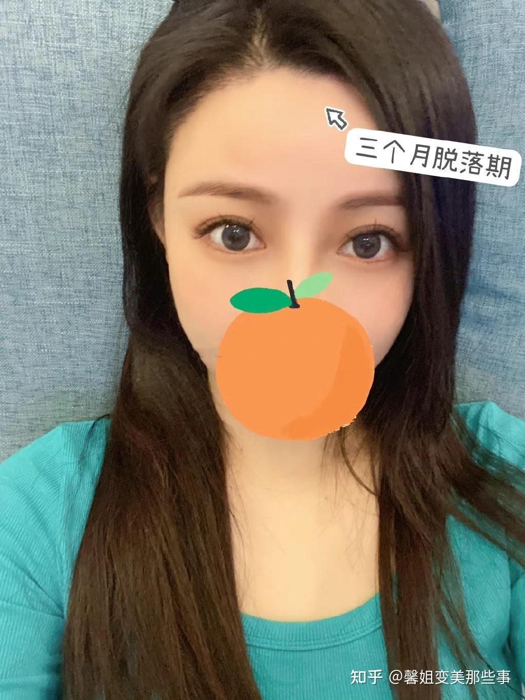 植发后遮盖了整个脸型?堪比整容(附带详细对比图) - 知乎