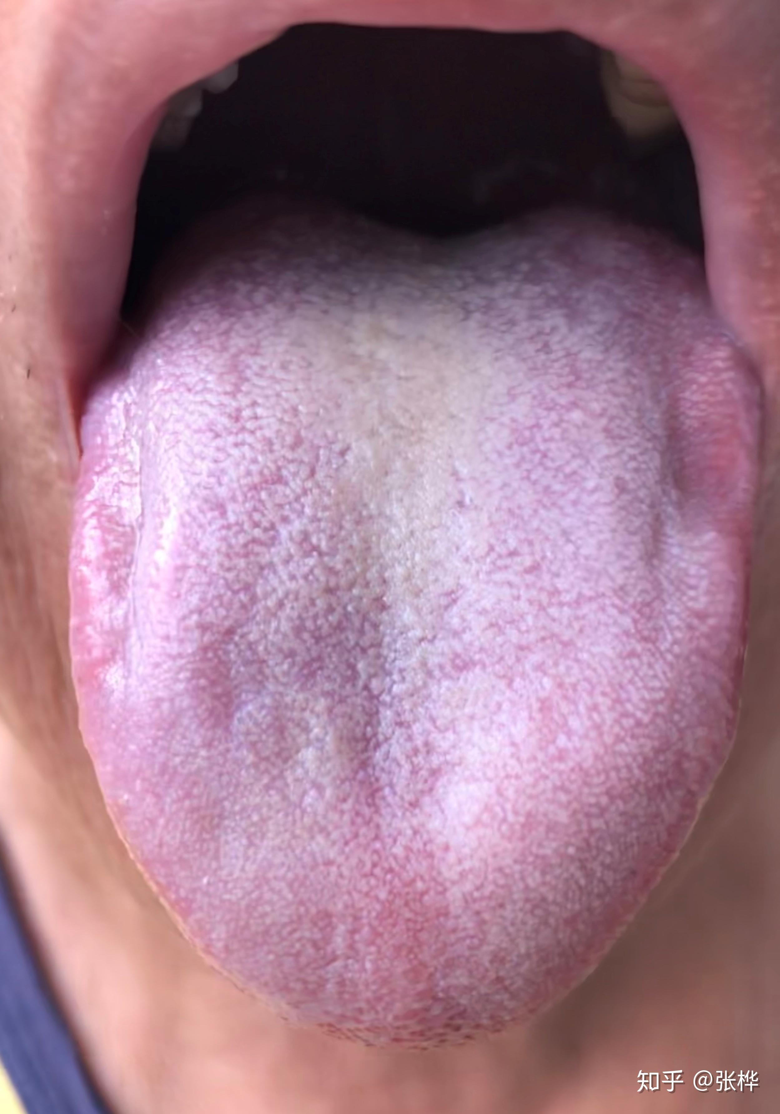 舌诊:舌苔黄白腻,舌质紫暗,舌边齿印深.脉诊:两脉洪强,以右关为著.