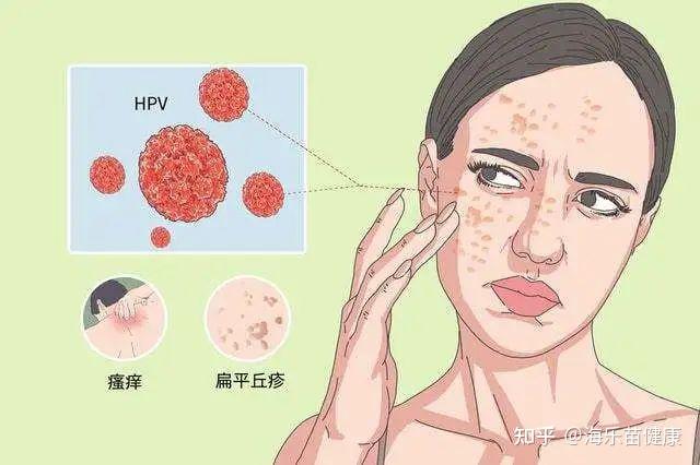 hpv感染面部图片高危图片