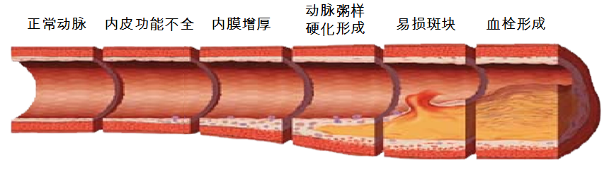99%的血栓无任何征兆!记住一个字,血栓不上身,一生无栓 - 知乎