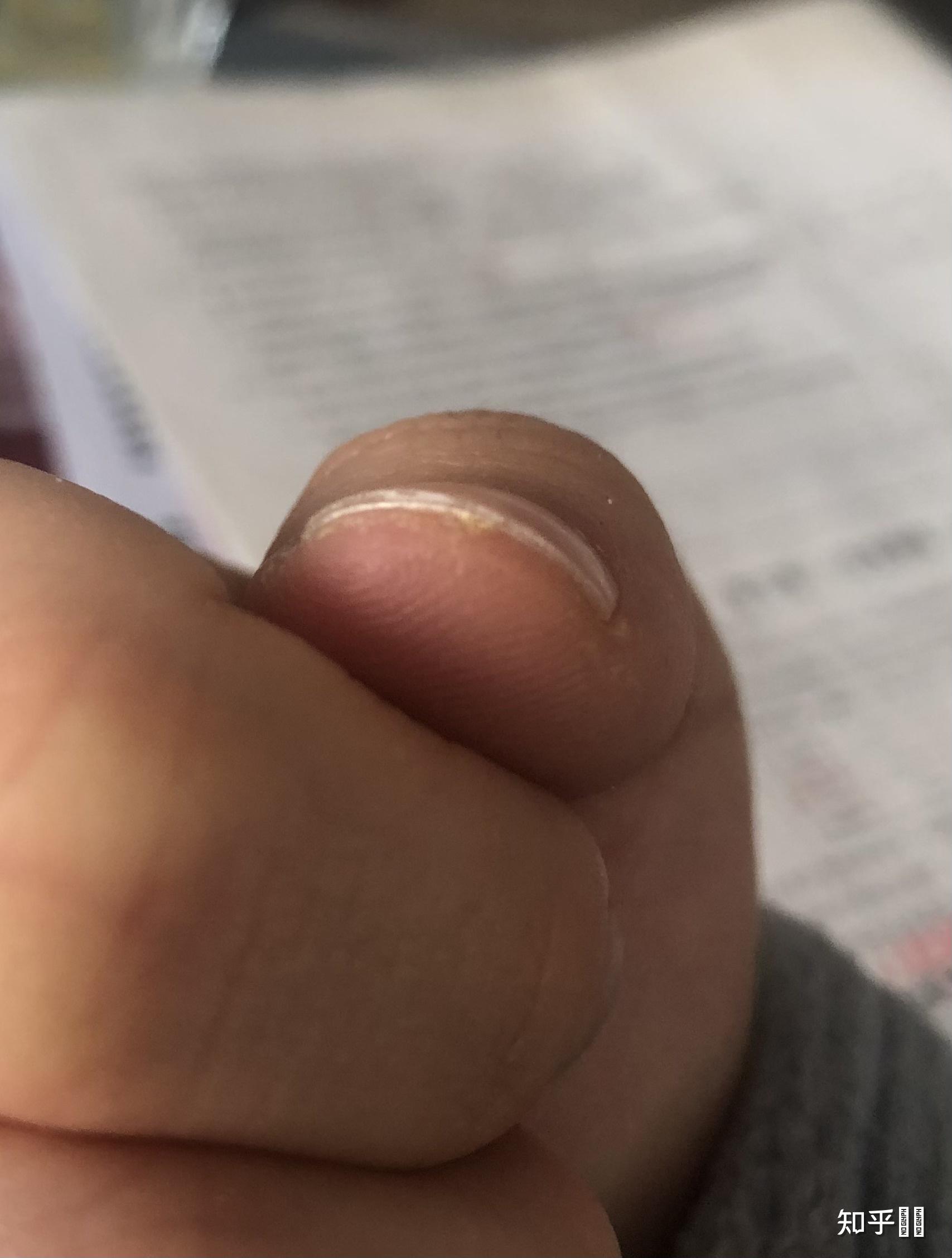 指甲尖部有一圈约1毫米宽呈白色