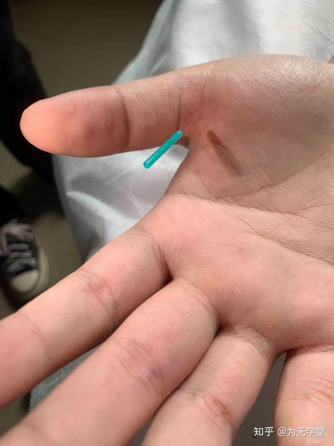 中风在中医里是怎么防治和特色调理的