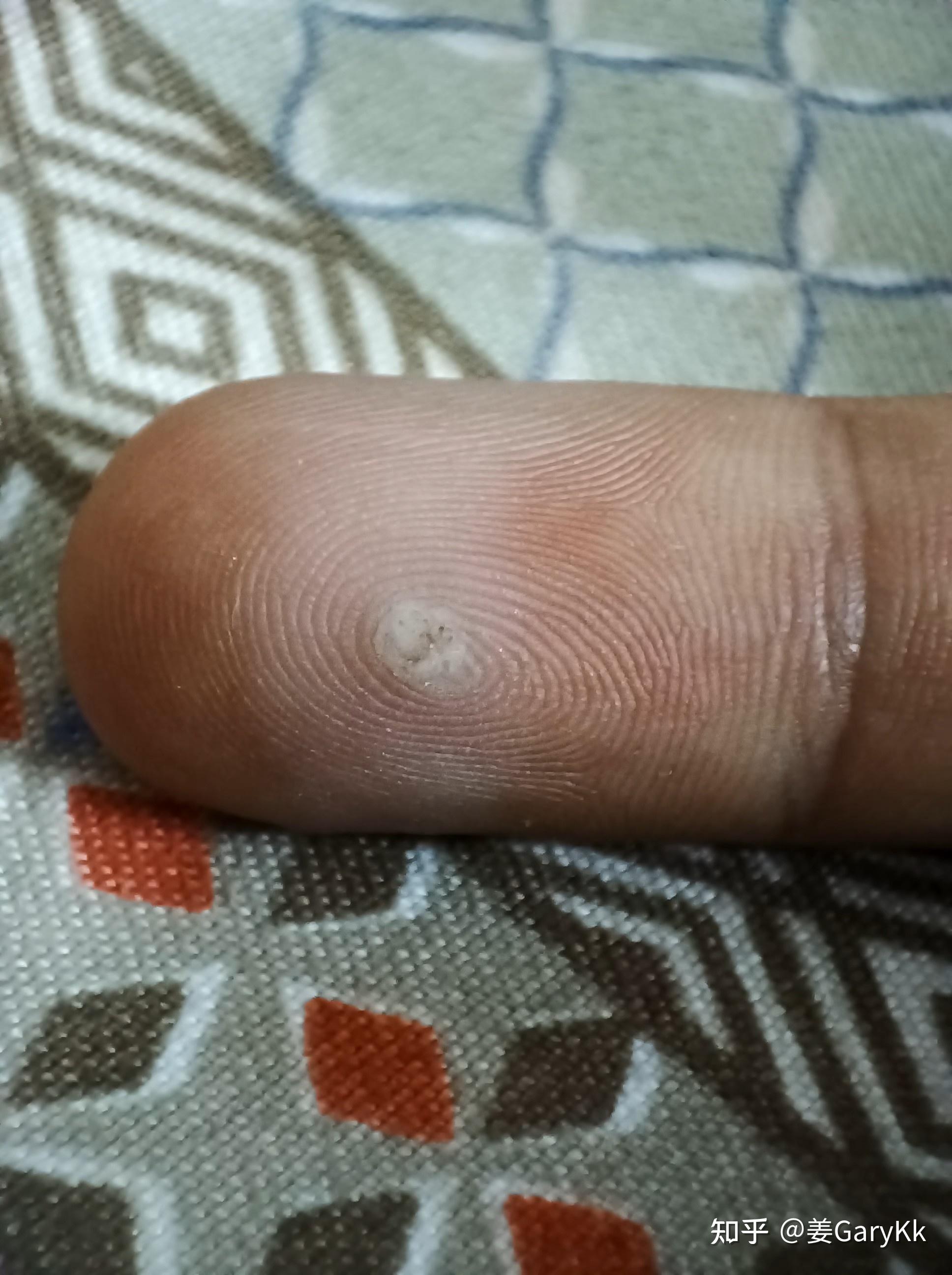 寻常疣治疗过程