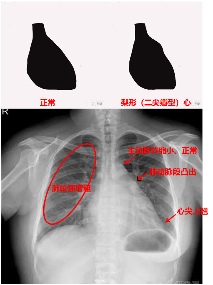 正常、异常心形 - 知乎