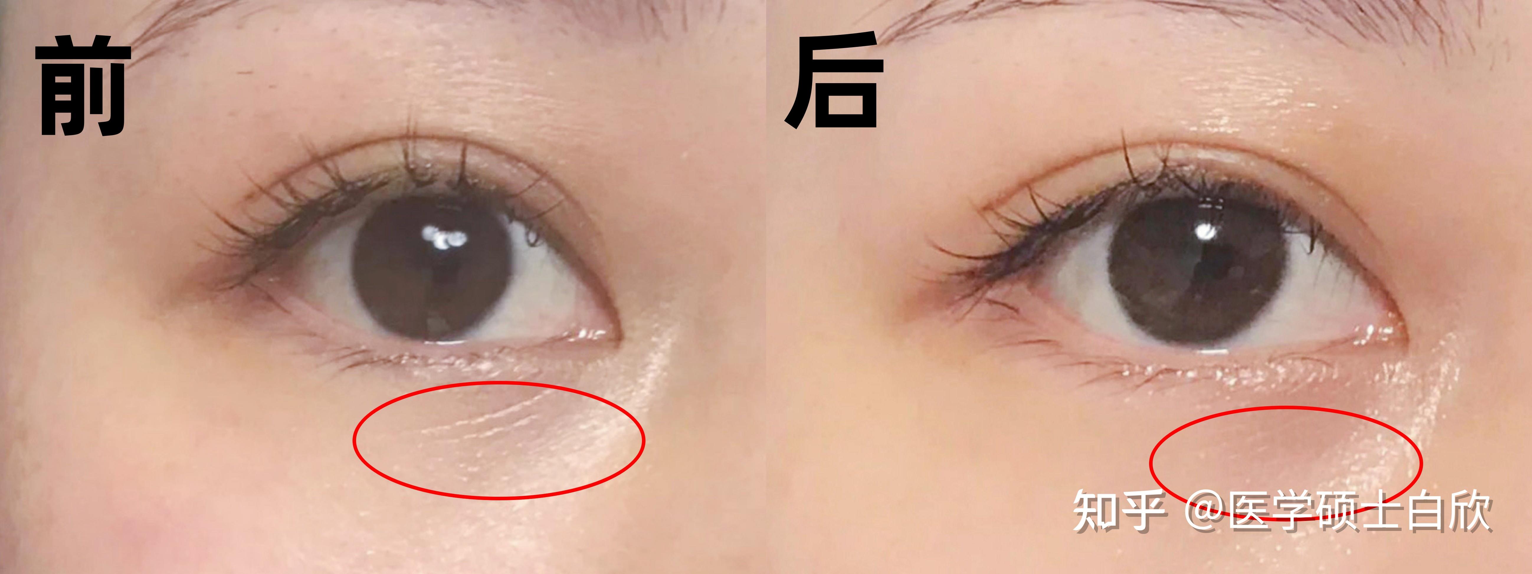皮肤科医生从来不买这类眼霜,普通人却花了很多钱去踩雷!!! - 知乎
