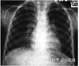 结核病 - 知乎