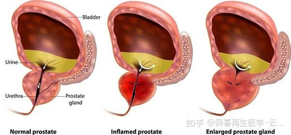 父亲节 过半男性都有前列腺疾病 干细胞拯救你的生命 腺 知乎
