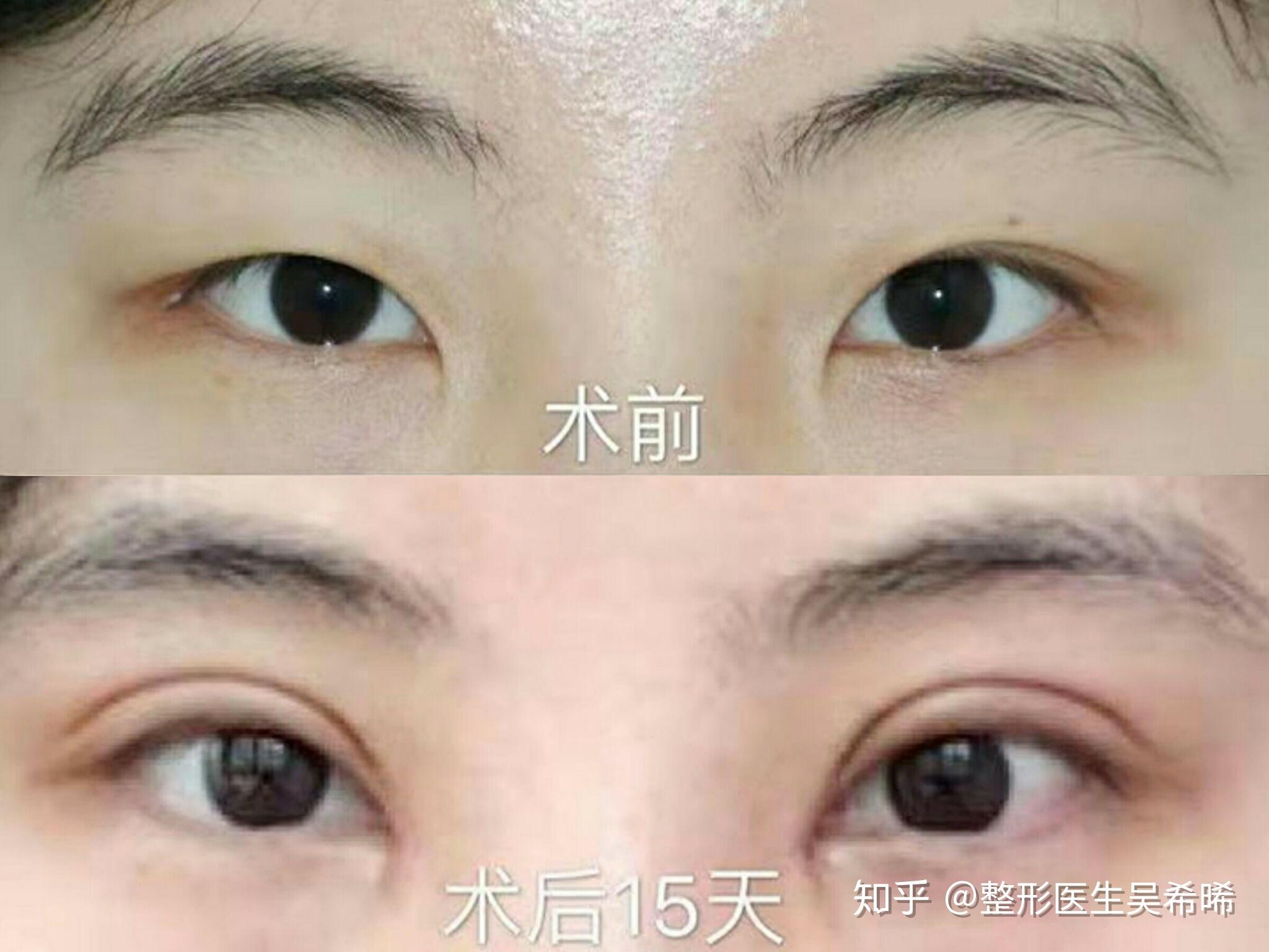 双眼皮修复（北京医院丁金萍）系列案例三十四 - 知乎
