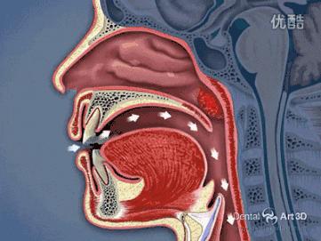 这就导致他们不得不选择用嘴巴呼吸,或者鼻呼吸口呼吸一起配合来吸入