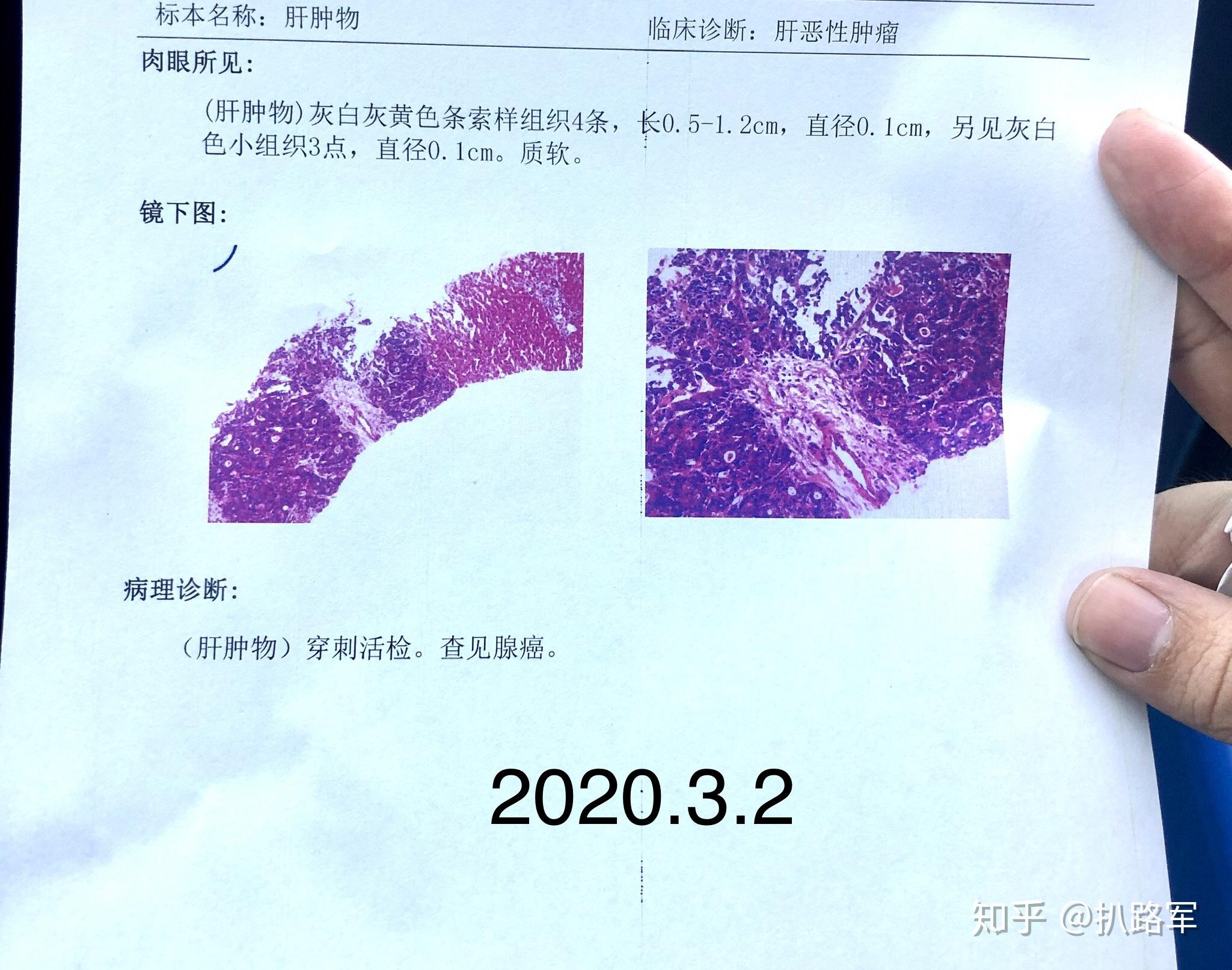 结肠癌,记录一些东西