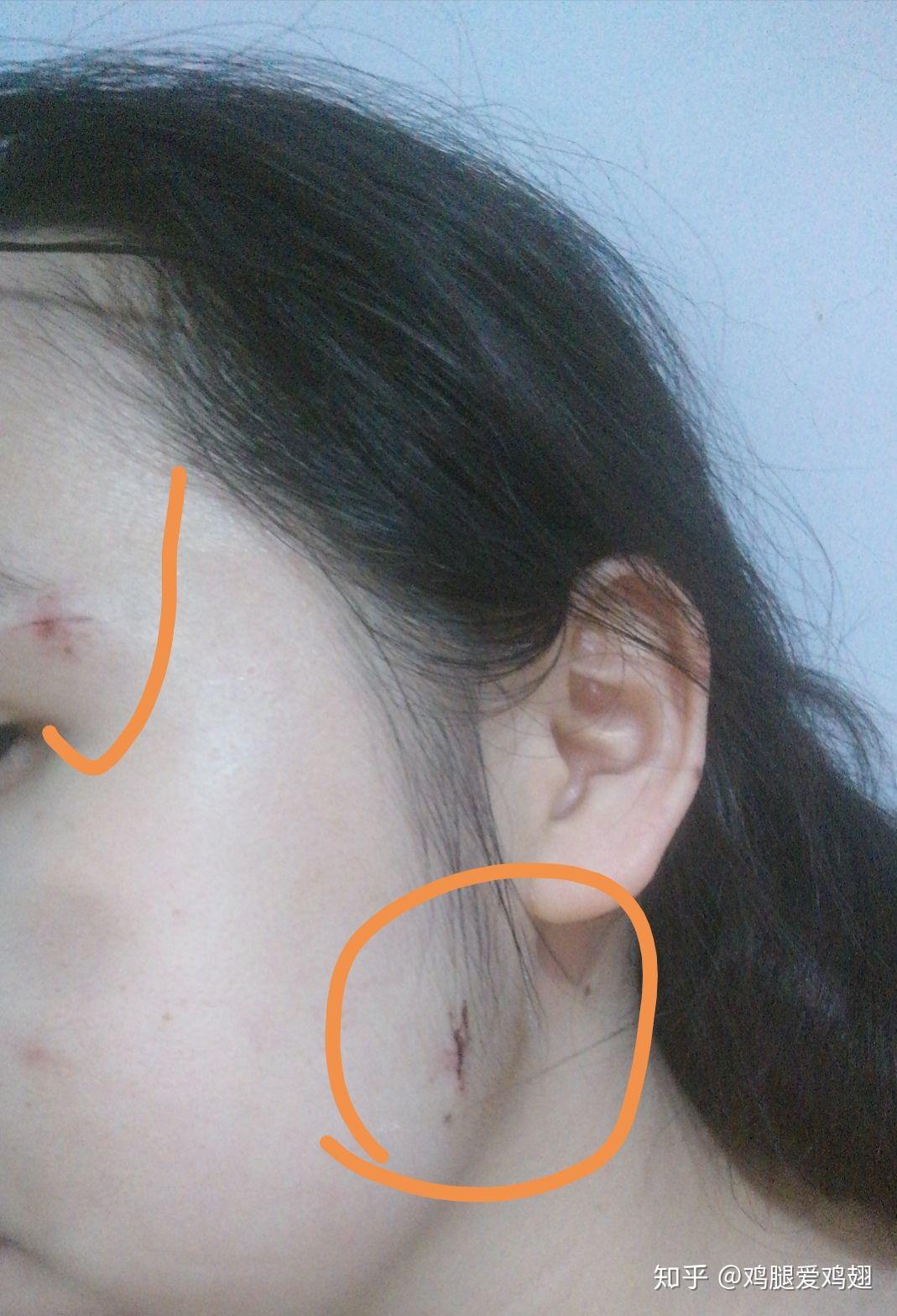 2020年6月10日市级三甲医院切痣日记