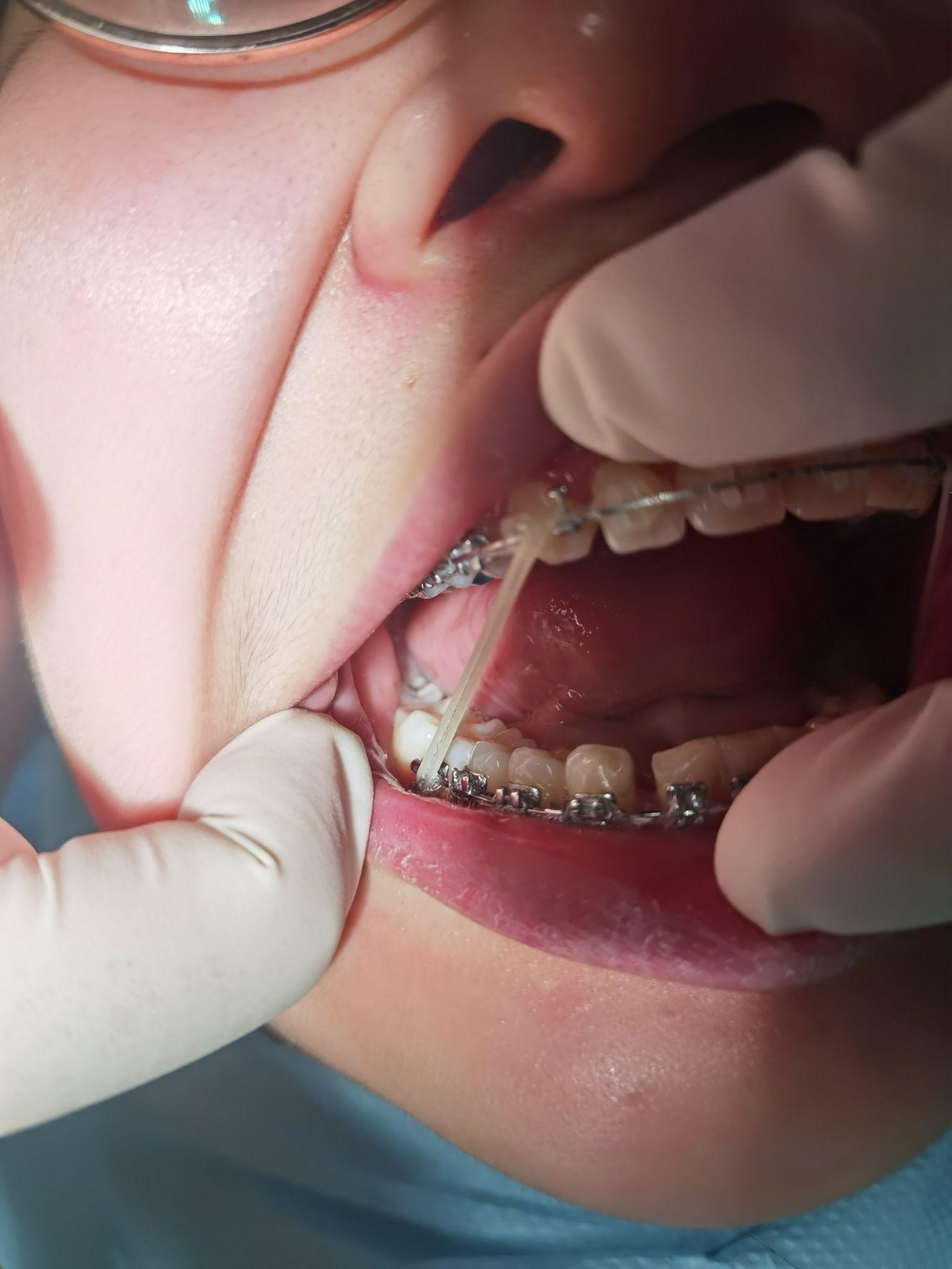 23岁女生正畸之路