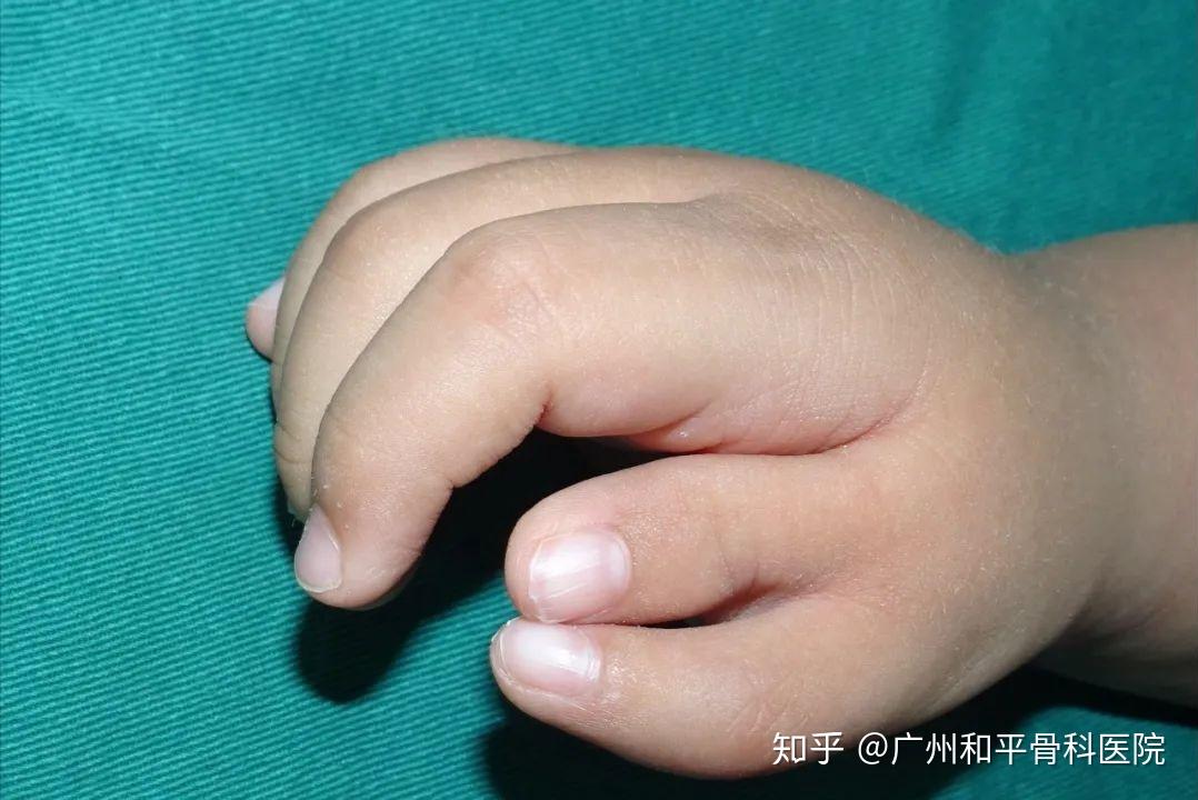 小指kirner畸形图图片