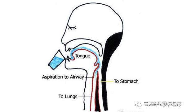 急性卒中患者吞咽筛查的常见问题思考