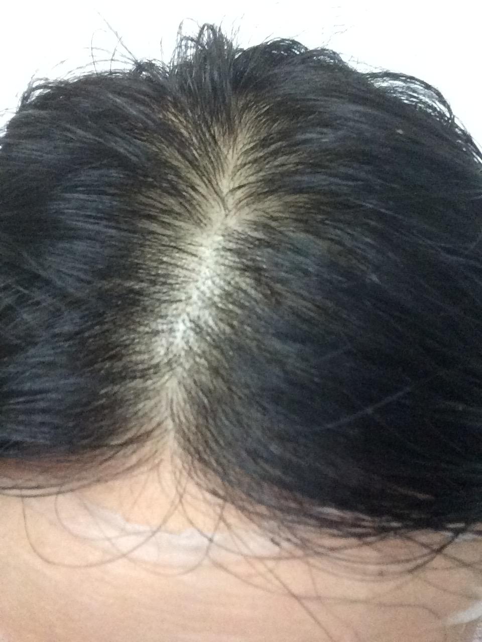 女生22,三年前发现头发越来越少,头发细软少,医