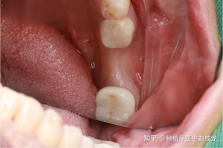鄭州種植牙|磨牙區多顆瑞士iti種植案例 - 知乎
