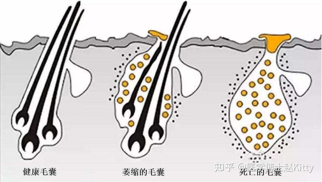 step1:抑制脱发因子dht,做好毛囊清洁