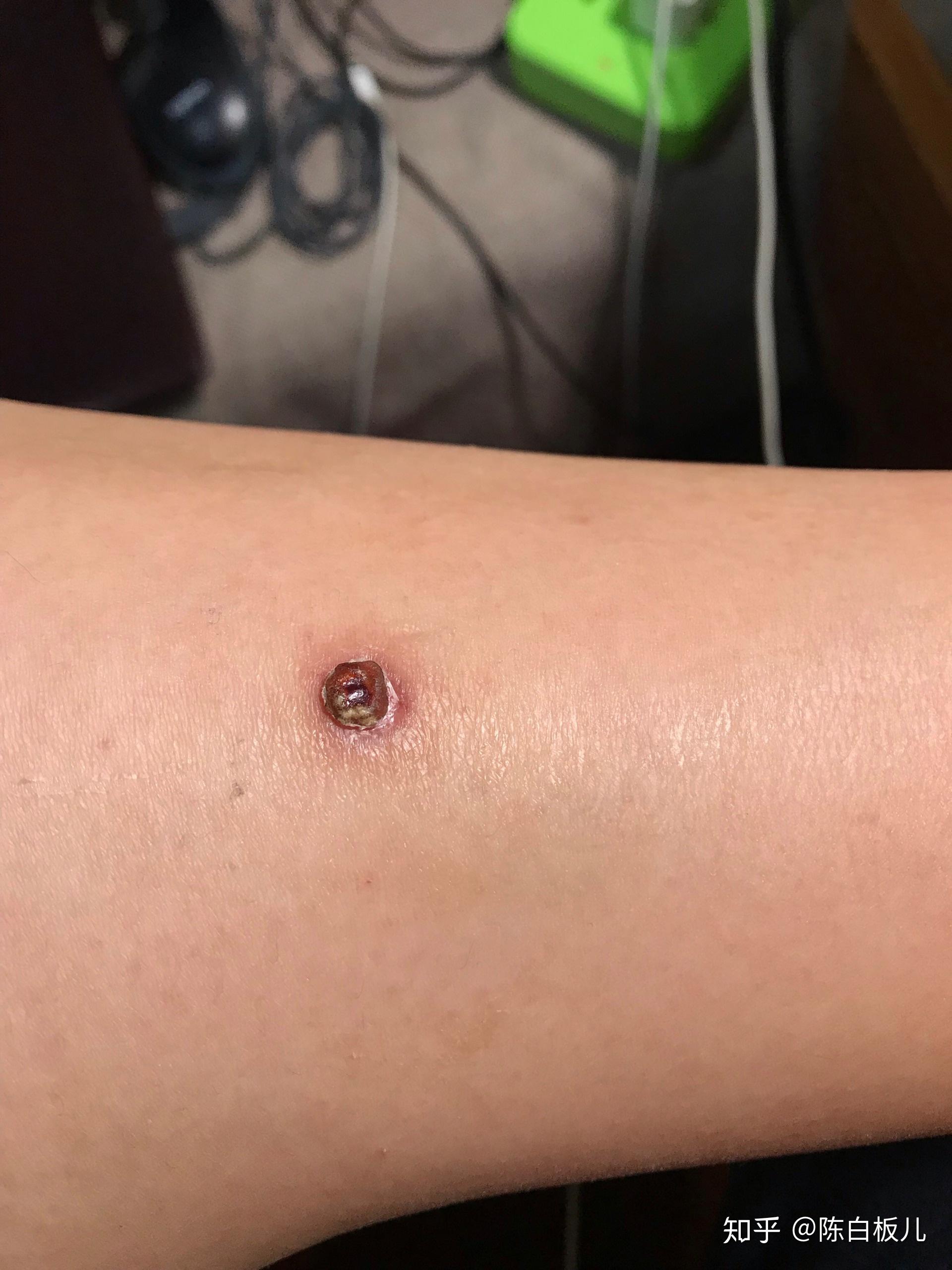 激光祛疣后如何避免留疤