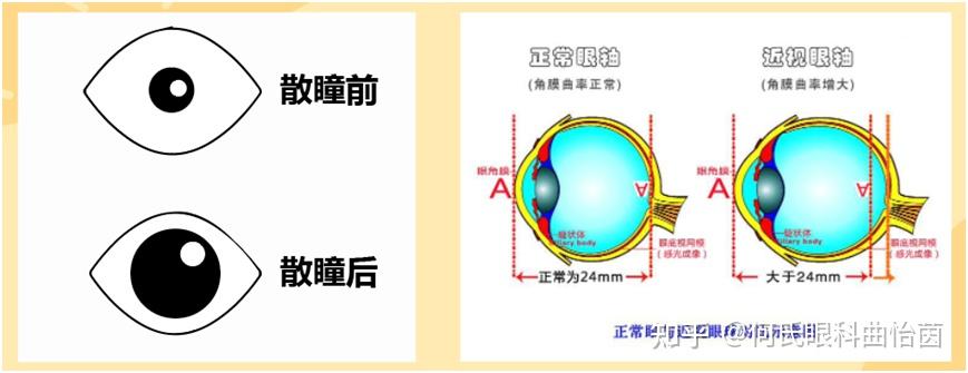 孩子近视了，有必要散瞳吗？ - 知乎