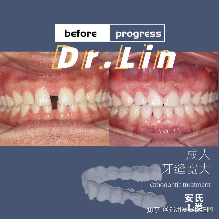 郑州牙齿矫正林范中线不齐牙缝宽大牙齿矫正案例