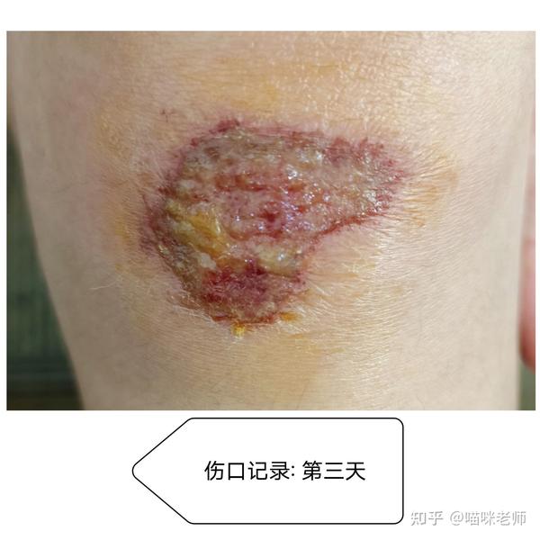 【膝盖摔伤恢复记录】记录恢复过程的皮肤变化 - 知乎