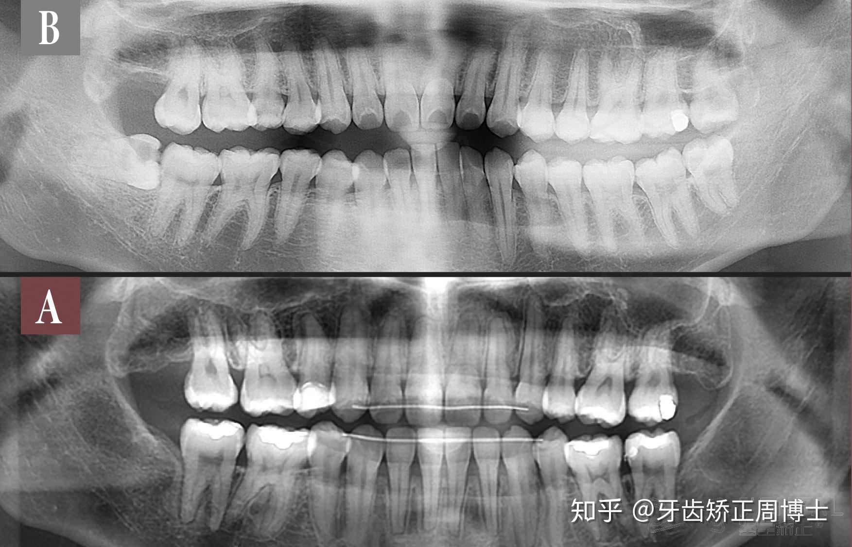 上頜前突下巴後縮露牙齦矯正案例