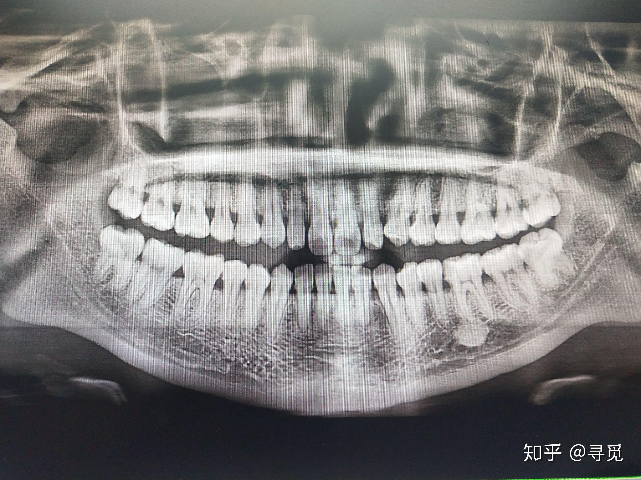 智齿长得很好即正位不痛是什么体验