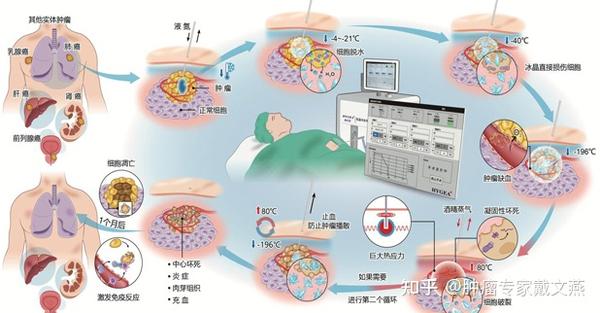 康博刀冷冻消融术——冷热双循环高效精准抗肿瘤 - 知乎