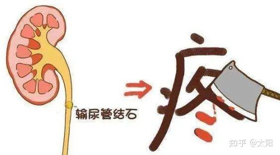 肾绞痛是输尿管结石的典型症状,通常是突然发生一侧腰背部剧烈疼痛