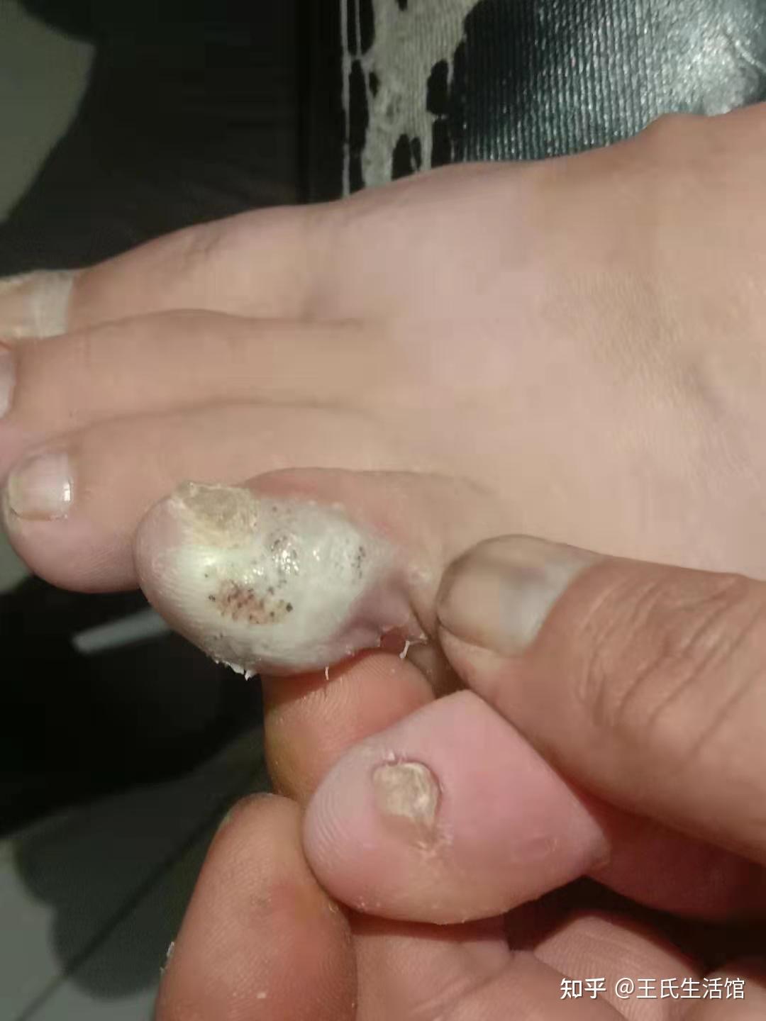 跖疣慢慢好转中全程不疼