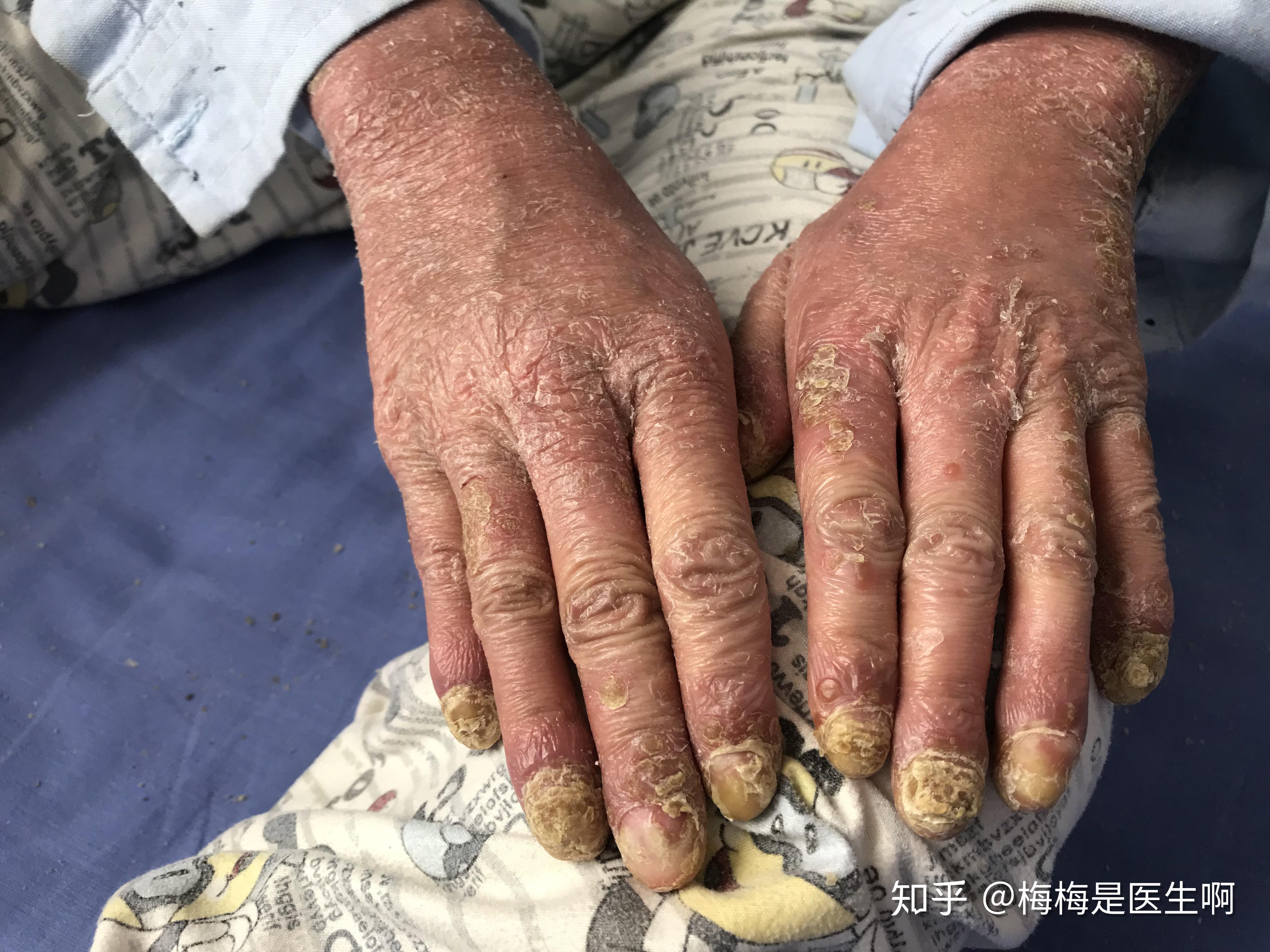  疫情患者治好之后有什么后遗症吗知乎视频(疫情治疗后的人)