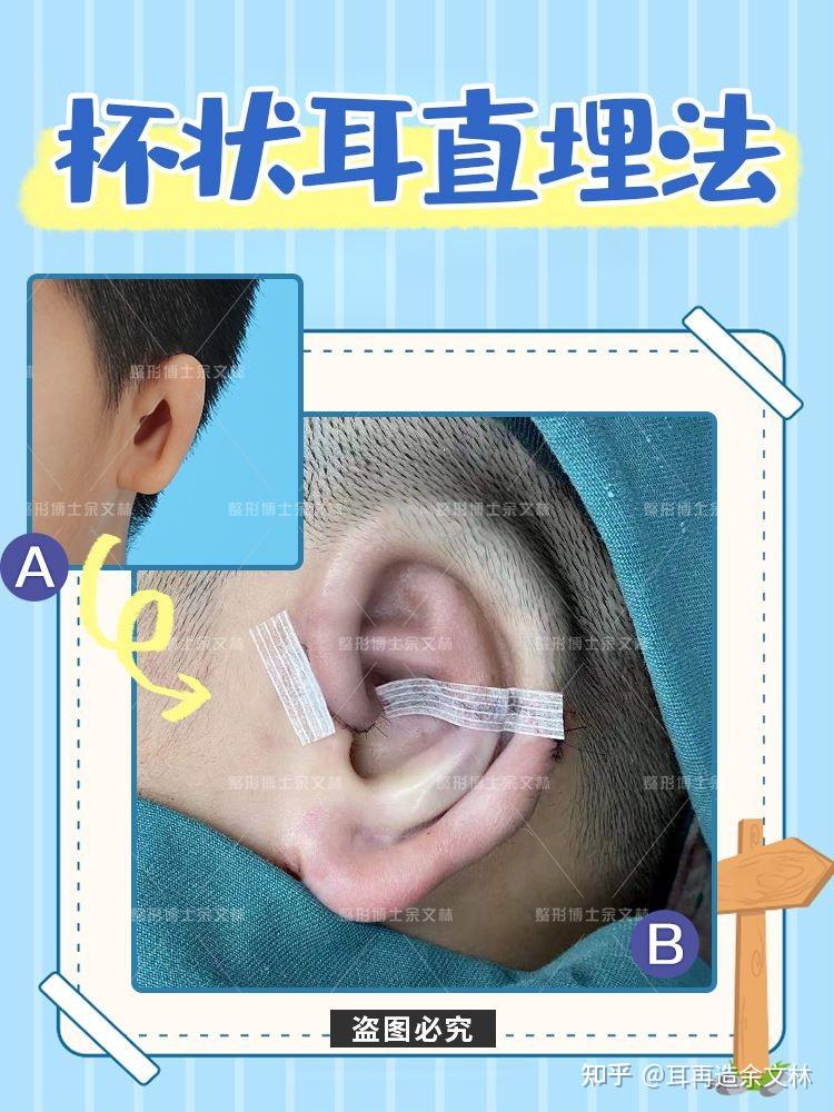 案例分析11歲的重度杯狀耳患者採用耳再造直埋法修復