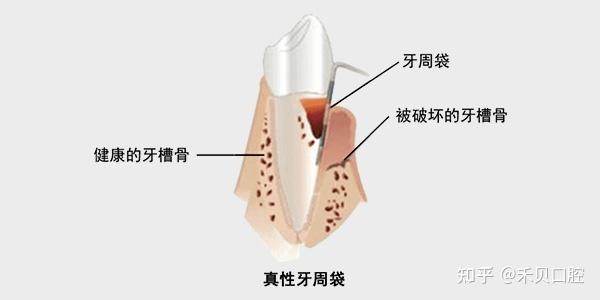 如何区分真性牙周袋与假性牙周袋? - 知乎