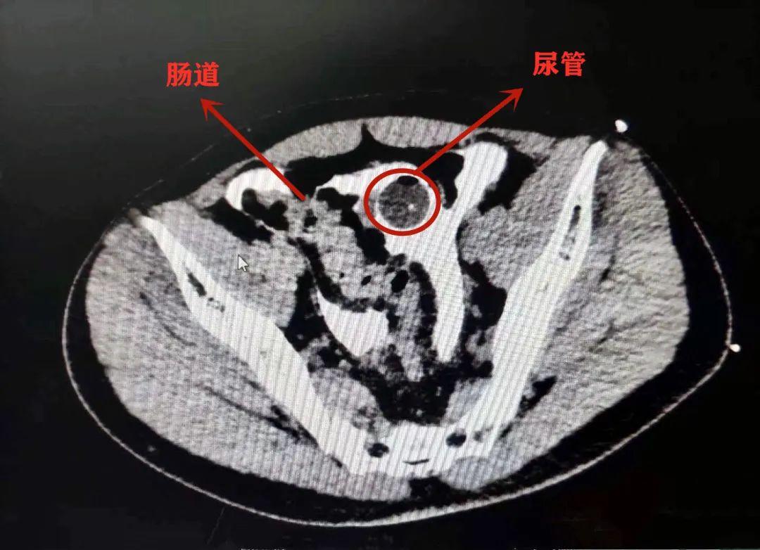 33岁成都小伙酒后憋尿摔一跤,膀胱磕破…破…破了?