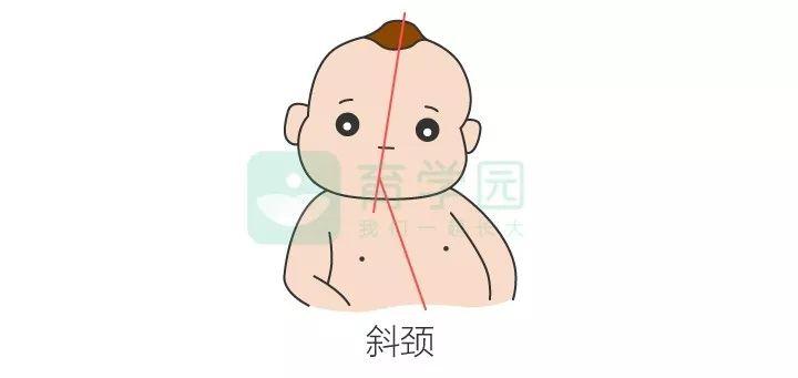 其实,斜颈就是宝宝的头部的中轴线与身体的中轴线不在一条线上.