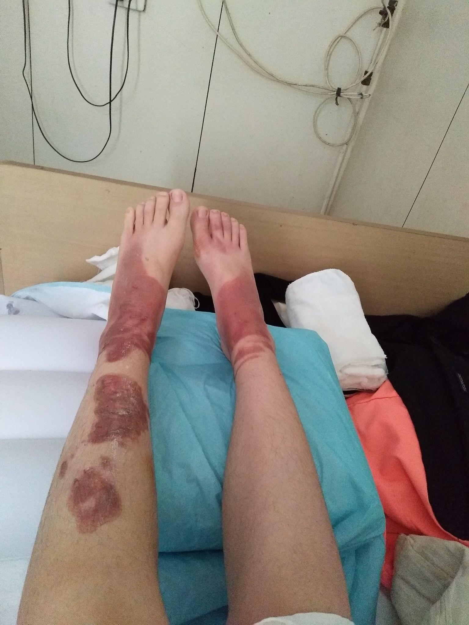 被开水烫伤冲冷水泡冷水半个小时左右但有的破皮了皮肤有点皱小水泡已