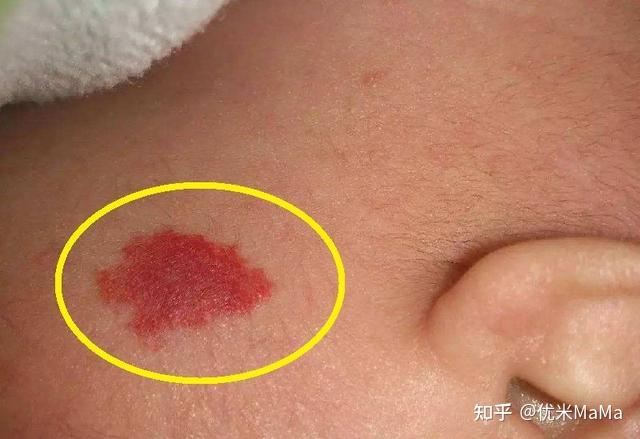 一般而言,80%的孩子出生都会或多或少带有胎记,但有的宝宝出生立刻