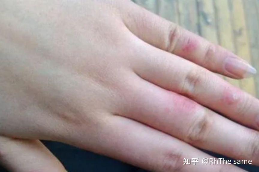 冻伤怎么处理?步骤 - 知乎